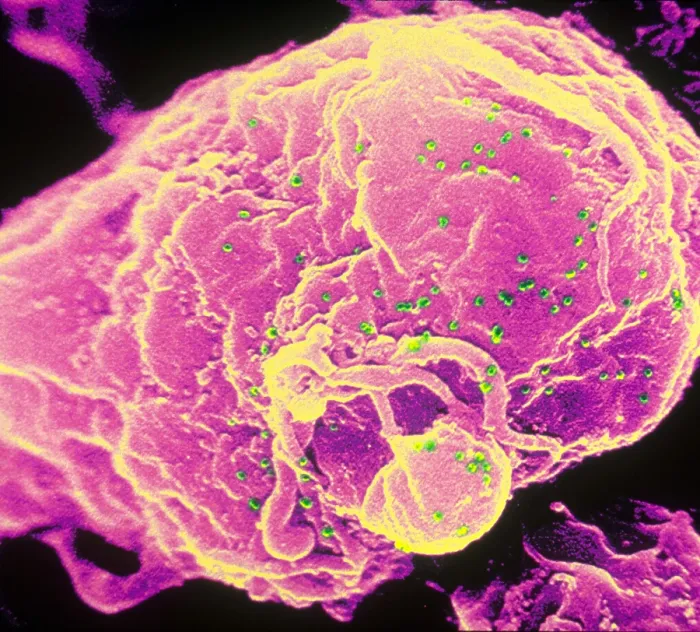 Framed Print : HIV-1 Infected T4 Lymphocyte (SEM) Framed Print : HIV-1 Infected T4 Lymphocyte (SEM)