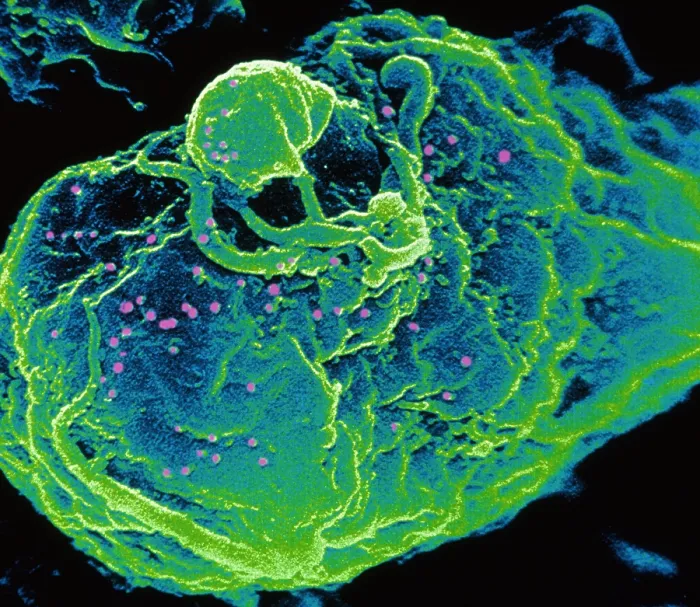 Framed Print : HIV infected T-cell Framed Print : HIV infected T-cell