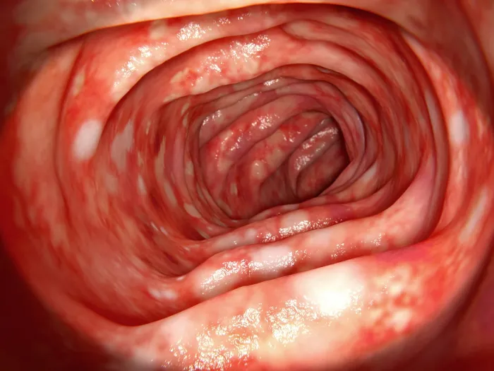 Framed Print : Human colon affected by ulcerative colitis Framed Print : Human colon affected by ulcerative colitis
