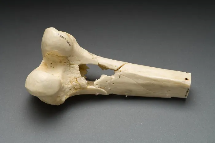 Framed Print : Human Distal Femur, Gunshot Wound, 1984 Framed Print : Human Distal Femur, Gunshot Wound, 1984