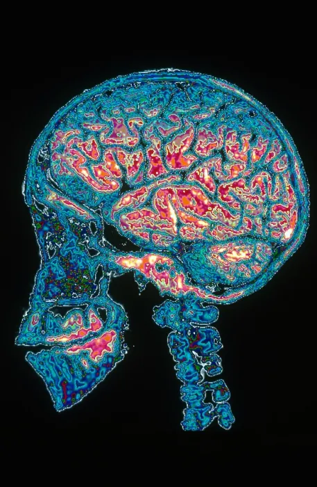 Framed Print : Human Skull X-Ray with Digitized Brain