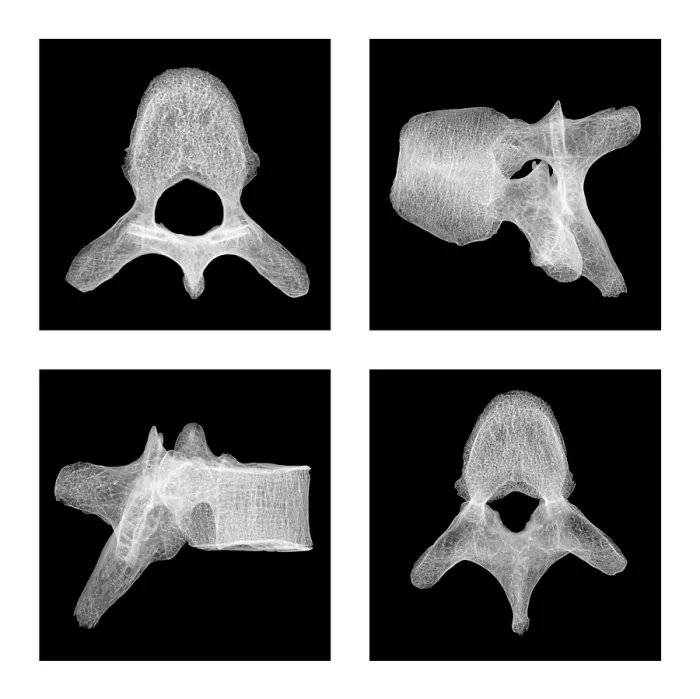 Framed Print : Human Vertebra T5, X-ray Framed Print : Human Vertebra T5, X-ray