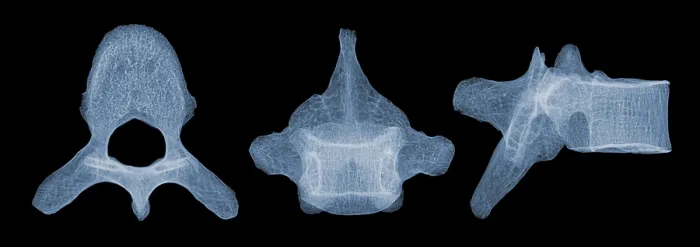 Framed Print : Human Vertebra T5, X-ray Framed Print : Human Vertebra T5, X-ray
