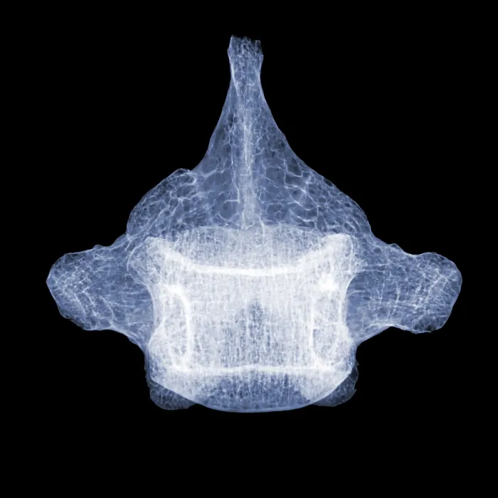 Framed Print : Human Vertebra T5, X-ray Framed Print : Human Vertebra T5, X-ray