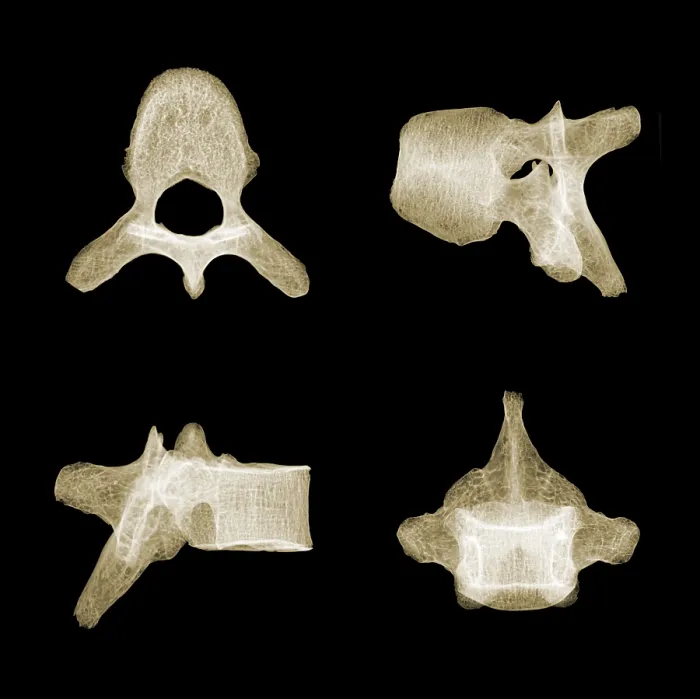 Framed Print : Human Vertebra T5, X-ray Framed Print : Human Vertebra T5, X-ray