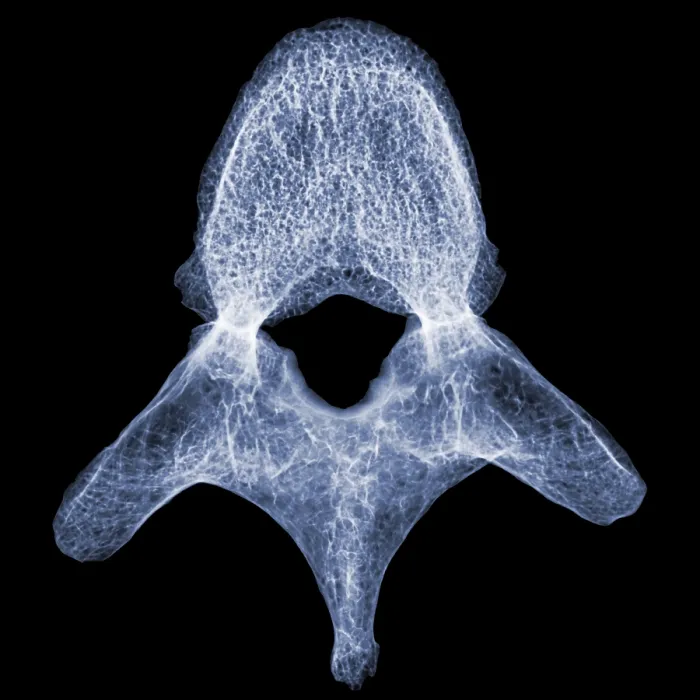 Framed Print : Human Vertebra T5, X-ray Framed Print : Human Vertebra T5, X-ray