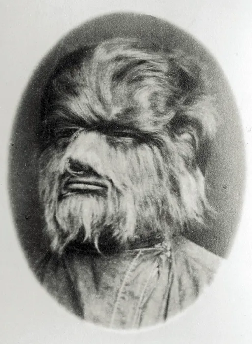 Framed Print : Hypertrichosis, 19th Century