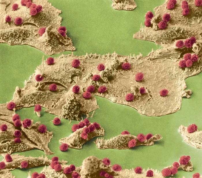 Framed Print : Immune Cells Attacking Cancer Cells, under a microscope (SEM) Framed Print : Immune Cells Attacking Cancer Cells, under a microscope (SEM)