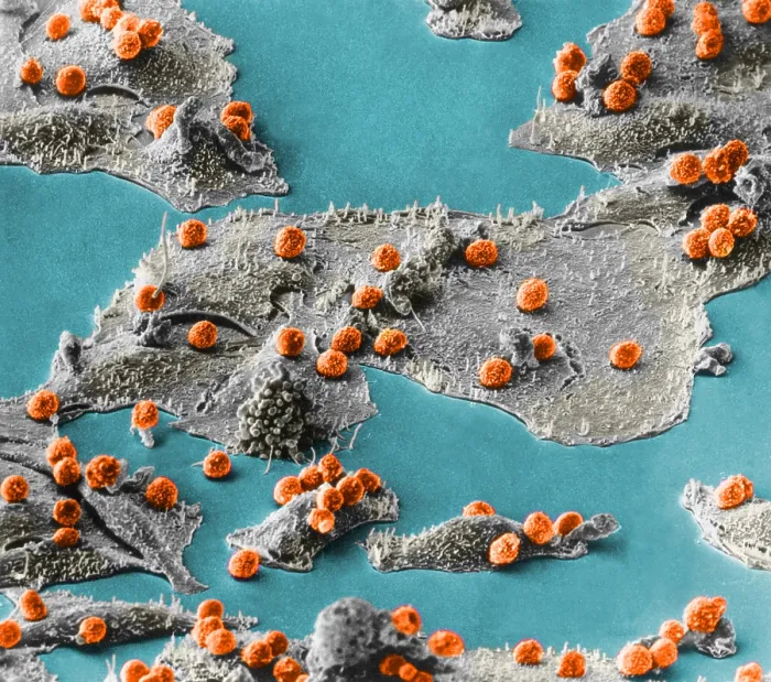Framed Print : Immune Cells Attacking Cancer Cells, under a microscope (SEM) Framed Print : Immune Cells Attacking Cancer Cells, under a microscope (SEM)