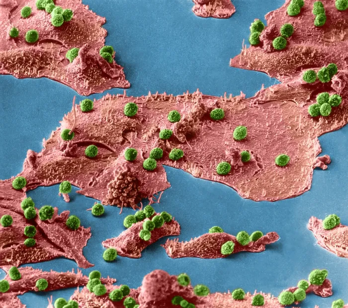 Framed Print : Immune Cells Attacking Cancer Cells, under a microscope (SEM) Framed Print : Immune Cells Attacking Cancer Cells, under a microscope (SEM)