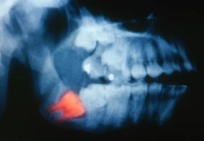 Framed Print : Impacted Wisdom Tooth, X-ray Framed Print : Impacted Wisdom Tooth, X-ray
