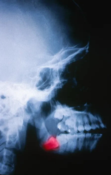 Framed Print : Impacted Wisdom Tooth, X-ray Framed Print : Impacted Wisdom Tooth, X-ray