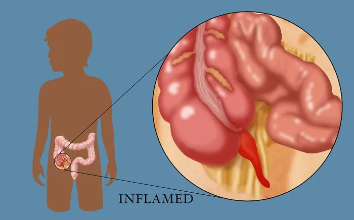 Framed Print : Inflamed Appendix Framed Print : Inflamed Appendix