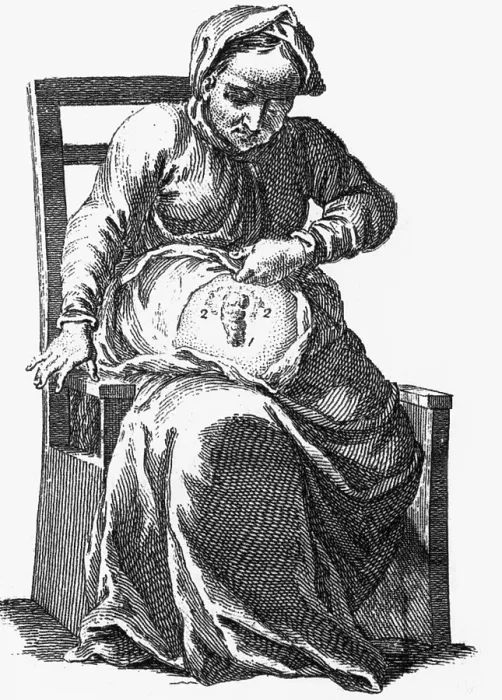 Framed Print : Intestinal Fistula Illustration