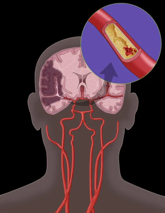Framed Print : Ischemic Stroke, Illustration Framed Print : Ischemic Stroke, Illustration