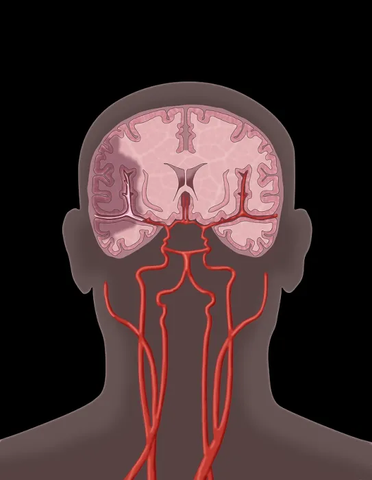 Framed Print : Ischemic Stroke, Illustration
