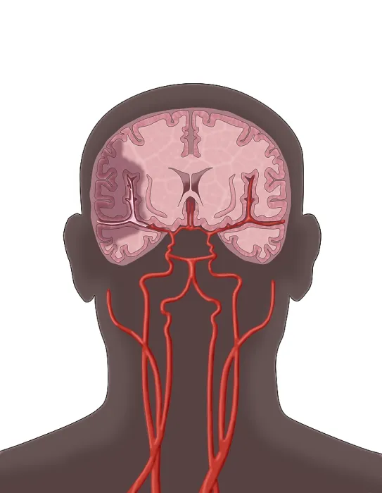Framed Print : Ischemic Stroke, Illustration