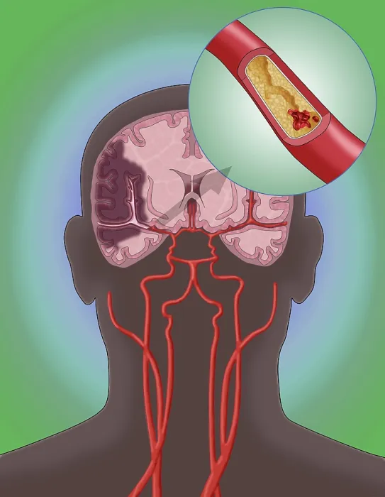 Framed Print : Ischemic Stroke, Illustration Framed Print : Ischemic Stroke, Illustration