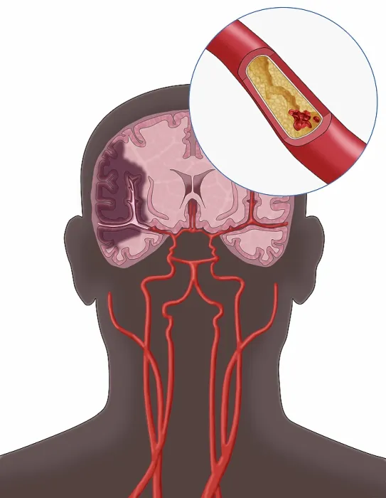 Framed Print : Ischemic Stroke, Illustration Framed Print : Ischemic Stroke, Illustration