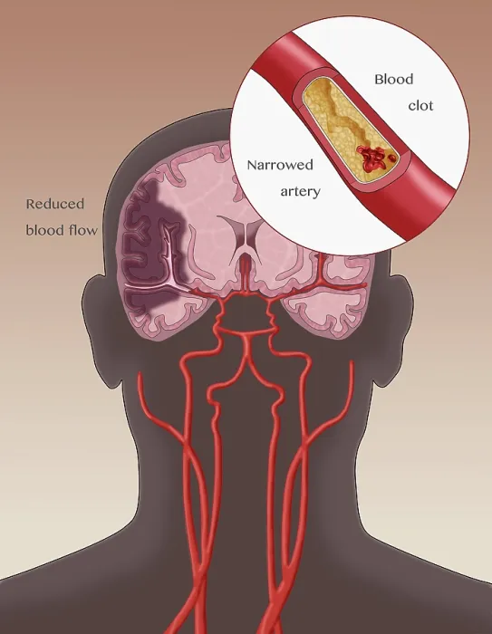 Framed Print : Ischemic Stroke, Illustration Framed Print : Ischemic Stroke, Illustration