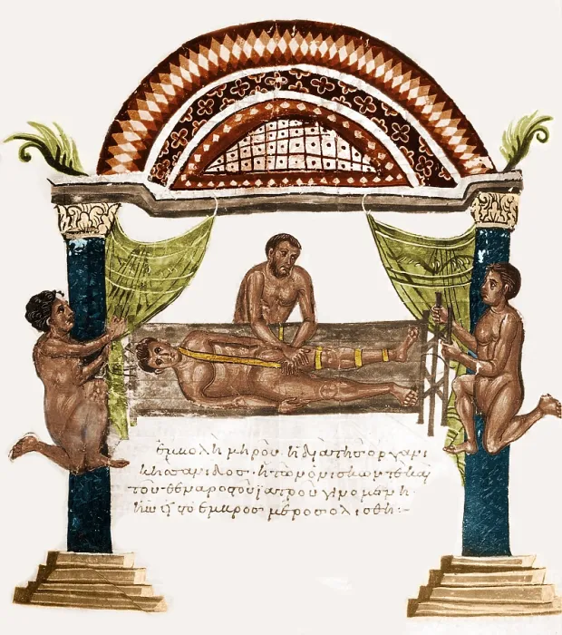Framed Print : Joint Dislocation Treatment, 1st Century BC Framed Print : Joint Dislocation Treatment, 1st Century BC