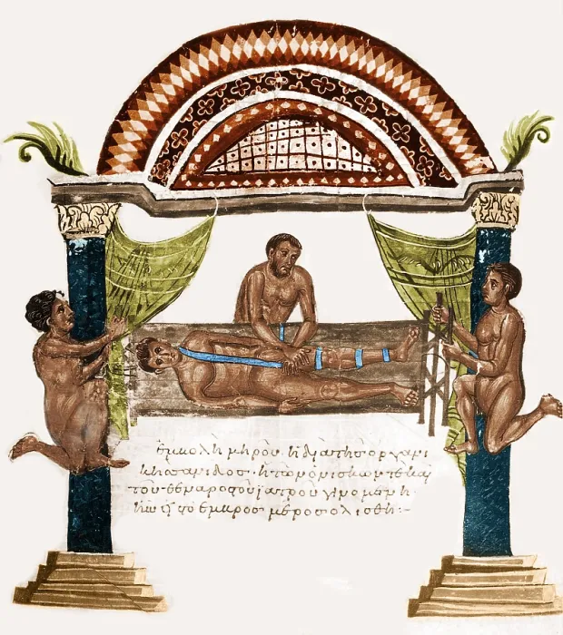 Framed Print : Joint Dislocation Treatment, 1st Century BC Framed Print : Joint Dislocation Treatment, 1st Century BC