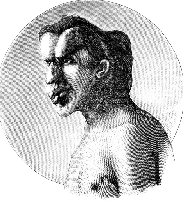 Framed Print : Joseph Merrick, The Elephant Man