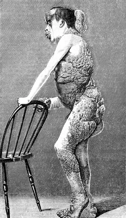 Framed Print : Joseph Merrick, The Elephant Man Framed Print : Joseph Merrick, The Elephant Man