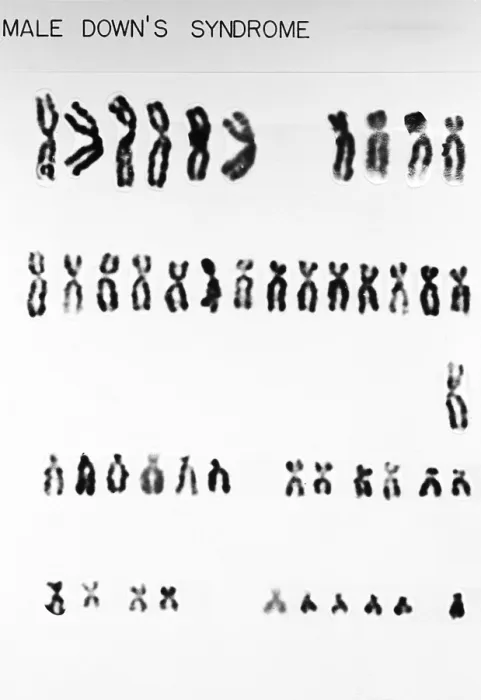 Framed Print : Karyotype, Down Syndrome