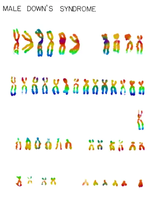 Framed Print : Karyotype, Down Syndrome Framed Print : Karyotype, Down Syndrome