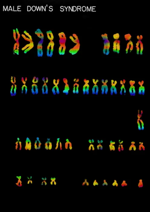 Framed Print : Karyotype, Down Syndrome