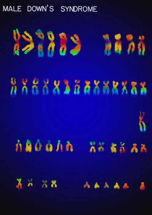 Framed Print : Karyotype, Down Syndrome