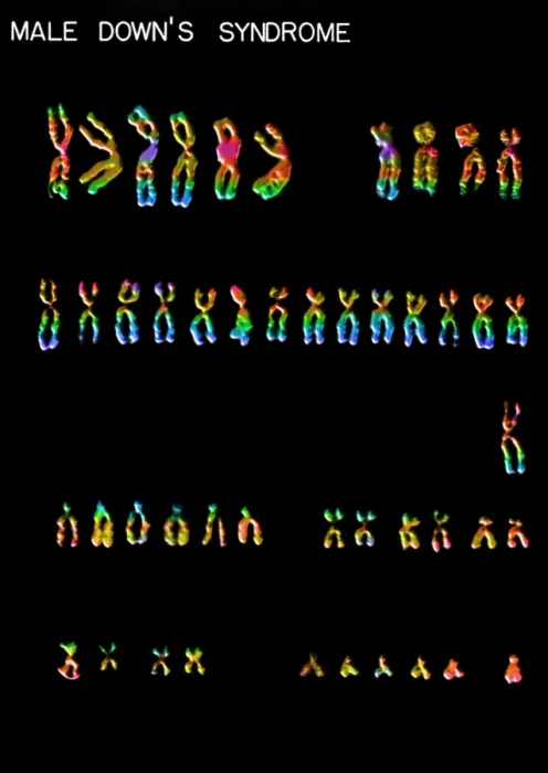 Framed Print : Karyotype, Down Syndrome Framed Print : Karyotype, Down Syndrome