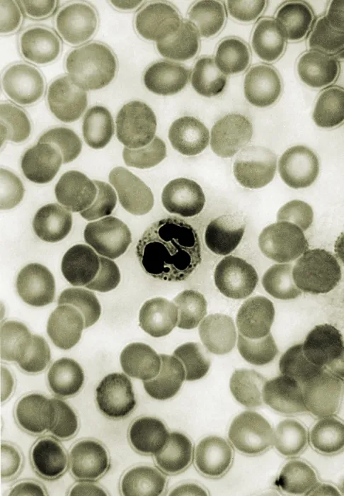 Framed Print : Leukocyte, Drumstick, light micrograph Framed Print : Leukocyte, Drumstick, light micrograph