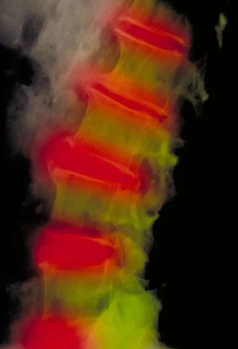 Framed Print : Lumbar spine x-ray, severe osteoarthritis Framed Print : Lumbar spine x-ray, severe osteoarthritis