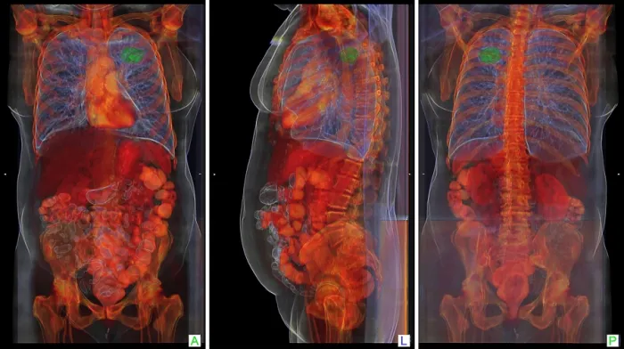 Framed Print : Lung Cancer, 3D CT Scan Framed Print : Lung Cancer, 3D CT Scan