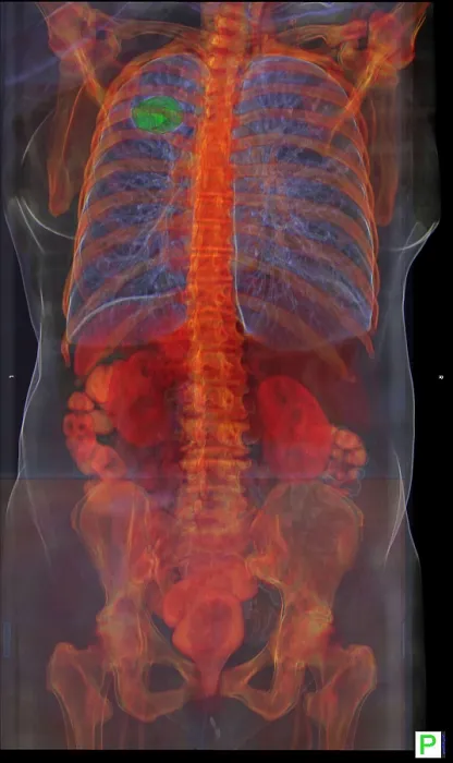 Framed Print : Lung Cancer, 3D CT Scan Framed Print : Lung Cancer, 3D CT Scan