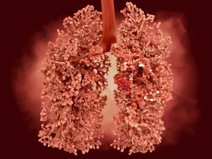 Framed Print : Lung cancer, artwork