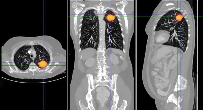 Framed Print : Lung Cancer, CT Scan