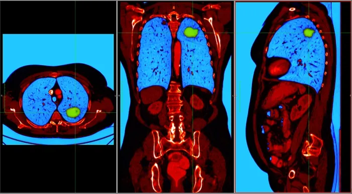 Framed Print : Lung Cancer, CT Scan