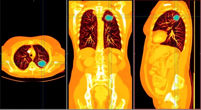 Framed Print : Lung Cancer, CT Scan