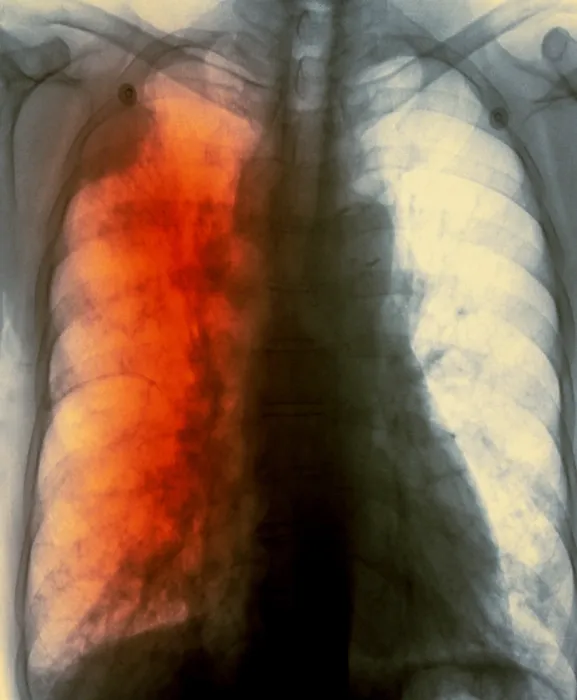 Framed Print : Lung cancer x-ray Framed Print : Lung cancer x-ray
