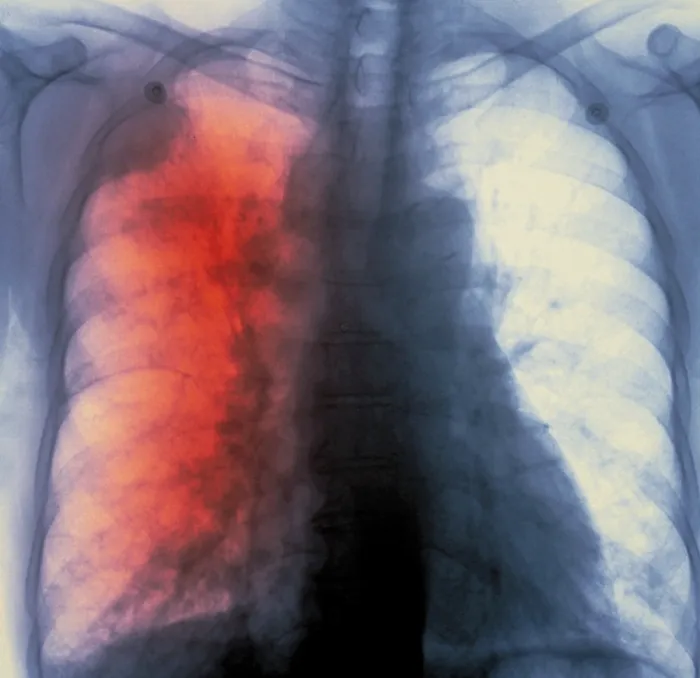 Framed Print : Lung cancer x-ray