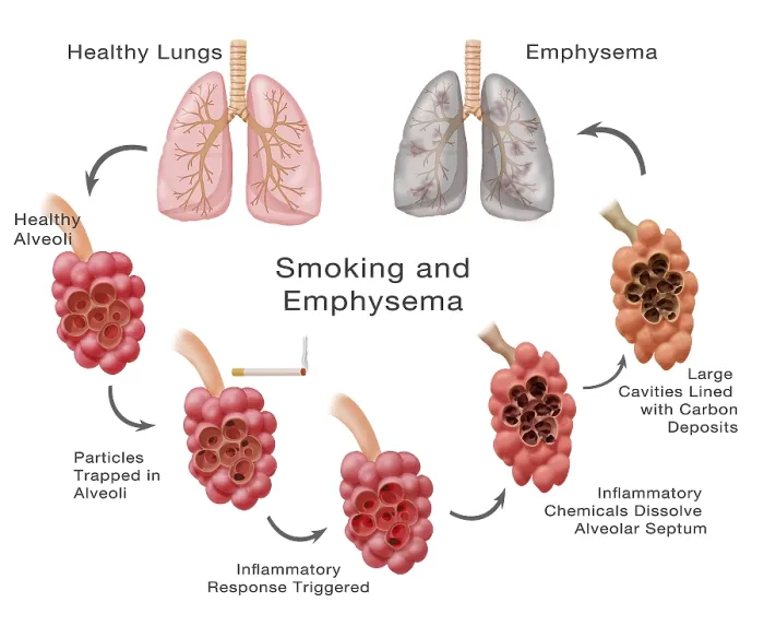 Framed Print : Lung Damage Leading to Emphysema Framed Print : Lung Damage Leading to Emphysema