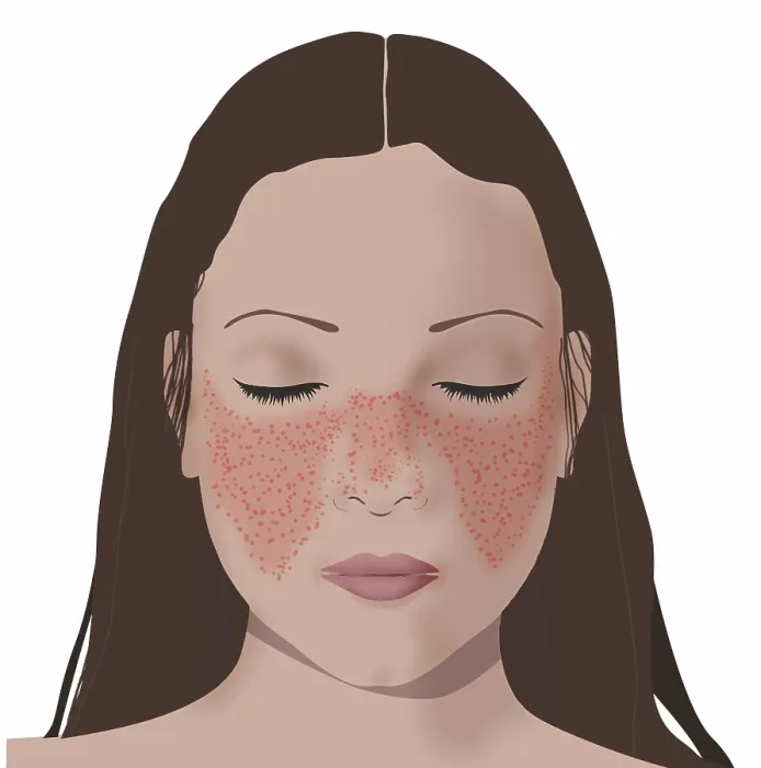 Framed Print : Lupus or systemic lupus erythematosus (SLE) butterfly shaped rash on woman's face, nose and cheeks, illustration Framed Print : Lupus or systemic lupus erythematosus (SLE) butterfly shaped rash on woman's face, nose and cheeks, illustration