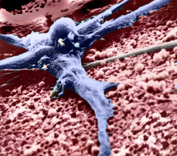 Framed Print : Malignant cancer cell
