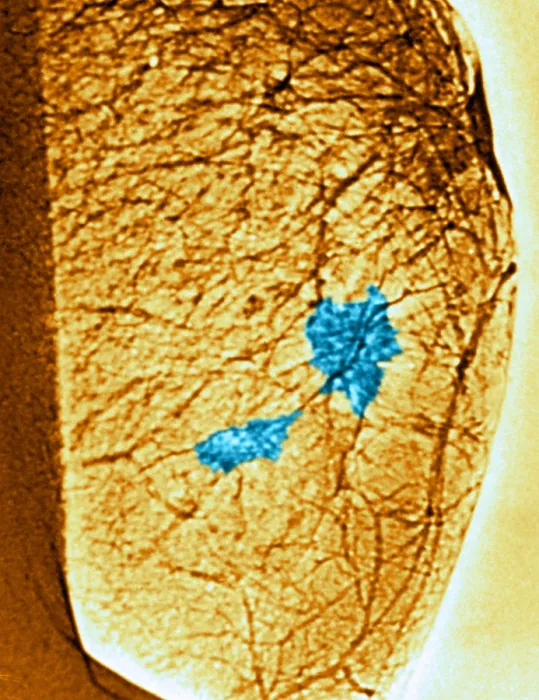 Framed Print : Mammogram. Color enhanced mammogram showing tumors in the breast tissue Framed Print : Mammogram. Color enhanced mammogram showing tumors in the breast tissue