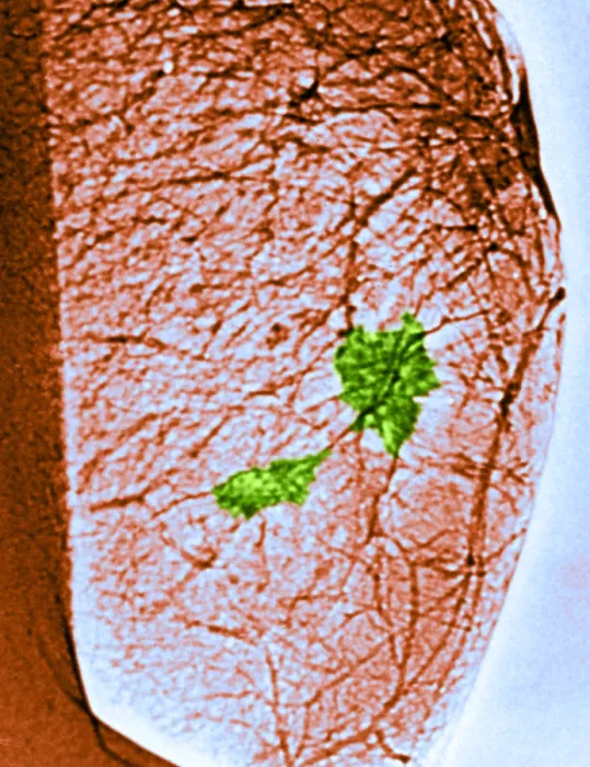 Framed Print : Mammogram. Color enhanced mammogram showing tumors in the breast tissue Framed Print : Mammogram. Color enhanced mammogram showing tumors in the breast tissue