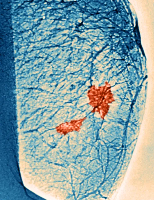 Framed Print : Mammogram. Color enhanced mammogram showing tumors in the breast tissue Framed Print : Mammogram. Color enhanced mammogram showing tumors in the breast tissue
