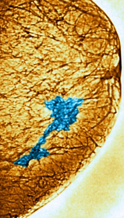 Framed Print : Mammogram. Color enhanced mammogram showing tumors in the breast tissue
